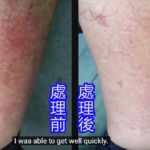 Muscle Inflammation Case