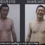 Psoriasis (Malaysia) 1